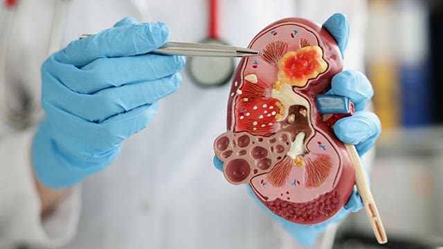 Common pain medication may protect kidney patients from dangerous toxins